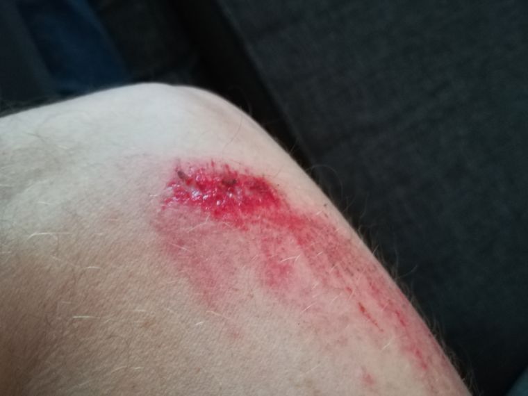 Road rash